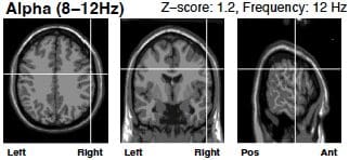 alpha wave brain scan after neurofeedback